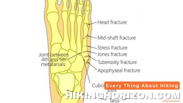 14 Common Foot Issues Experienced By Hikers! Prevent And Treat Foot ...